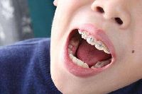【健康解碼】矯正牙齒真的可以瘦臉嗎？